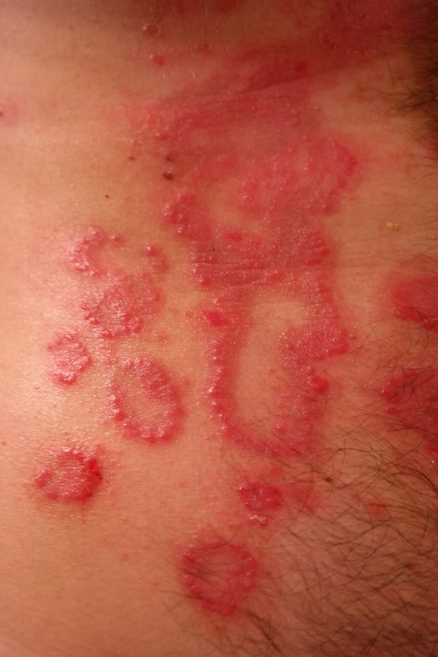 rash 356433 960 720